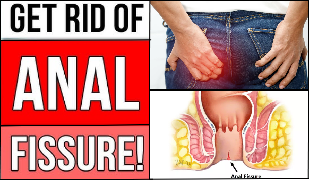 cure an anal fissure