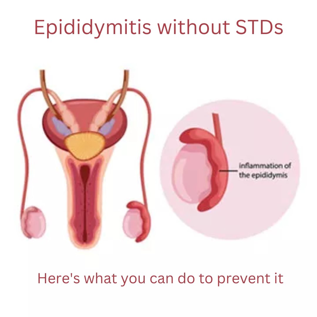 Epididymitis without STDs
