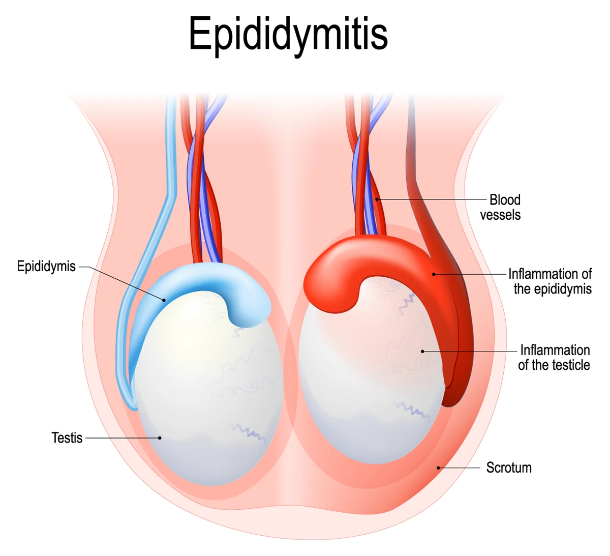 Epididymitis